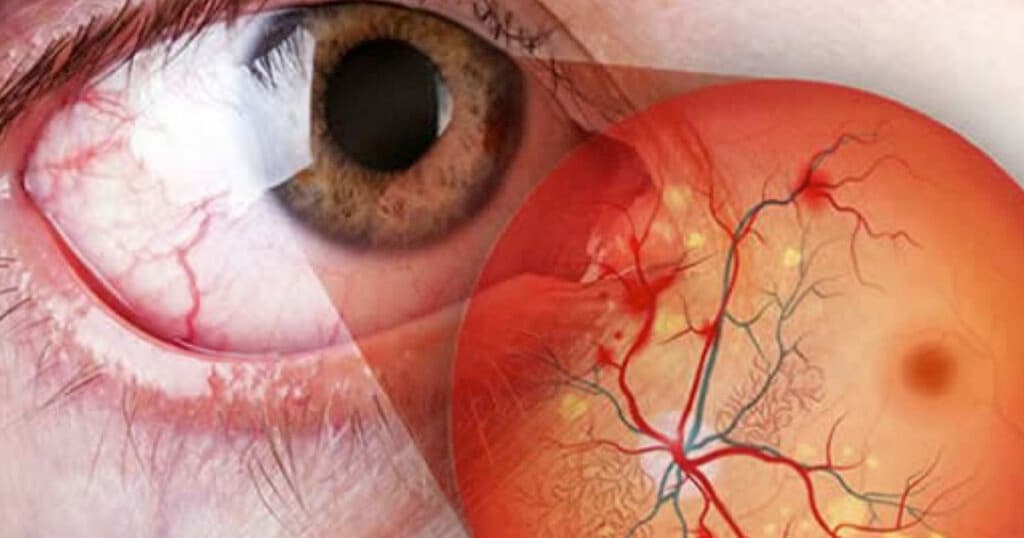 Retinopatia Diabética: o que é, Estágios e Tratamento