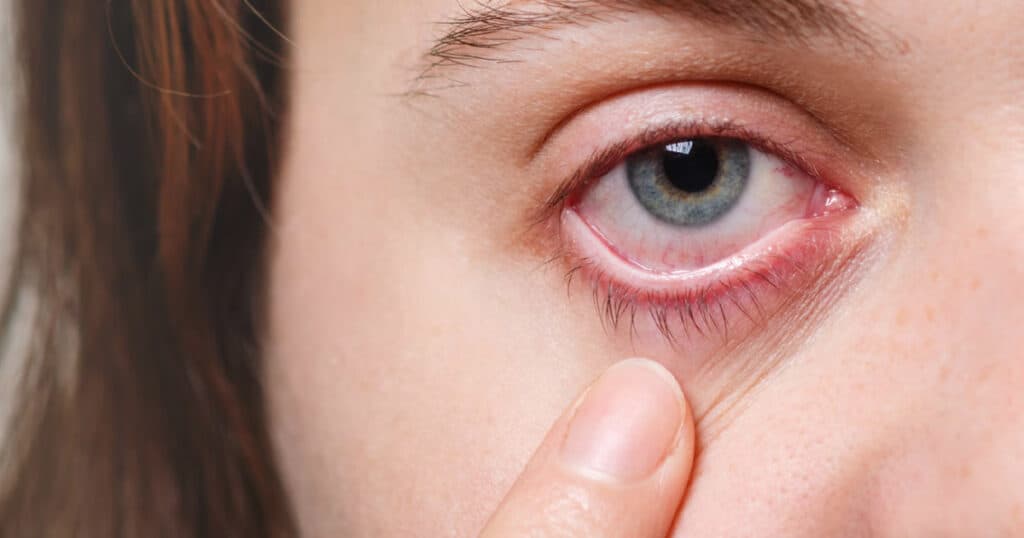 Terçol: o que é, causas e como tratar rápido