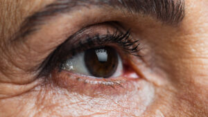 Olho humano com sinais de catarata, mostrando opacificação do cristalino que causa visão turva, condição comum associada ao envelhecimento.