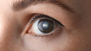 Olho humano com opacificação do cristalino, sinal comum da catarata