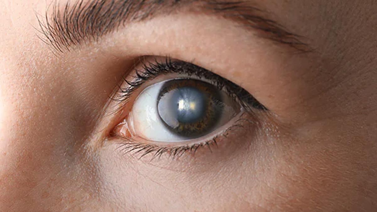 Olho humano com opacificação do cristalino, sinal comum da catarata