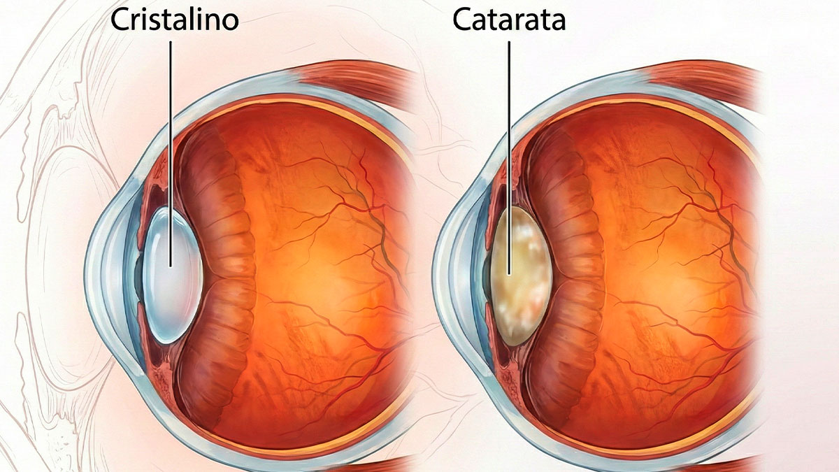 Ilustração do olho humano mostrando o cristalino saudável e o cristalino opaco na catarata
