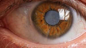 Leia mais sobre o artigo O que é catarata e como ela afeta a visão