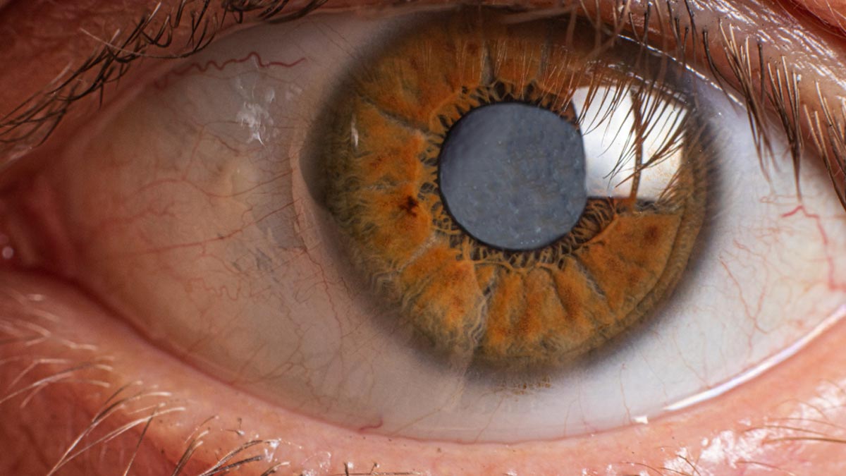 Olho de pessoa idosa com sinais de visão embaçada causada pela catarata